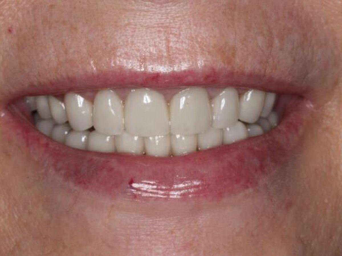Veneers: Case 34 — after