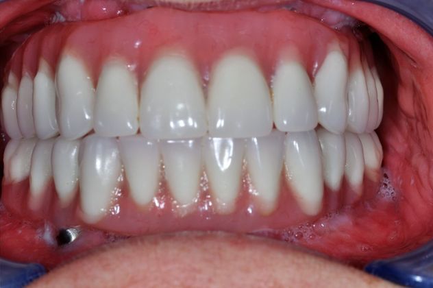 Teeth in a Day: Case 11 — Upper and Lower Arch after