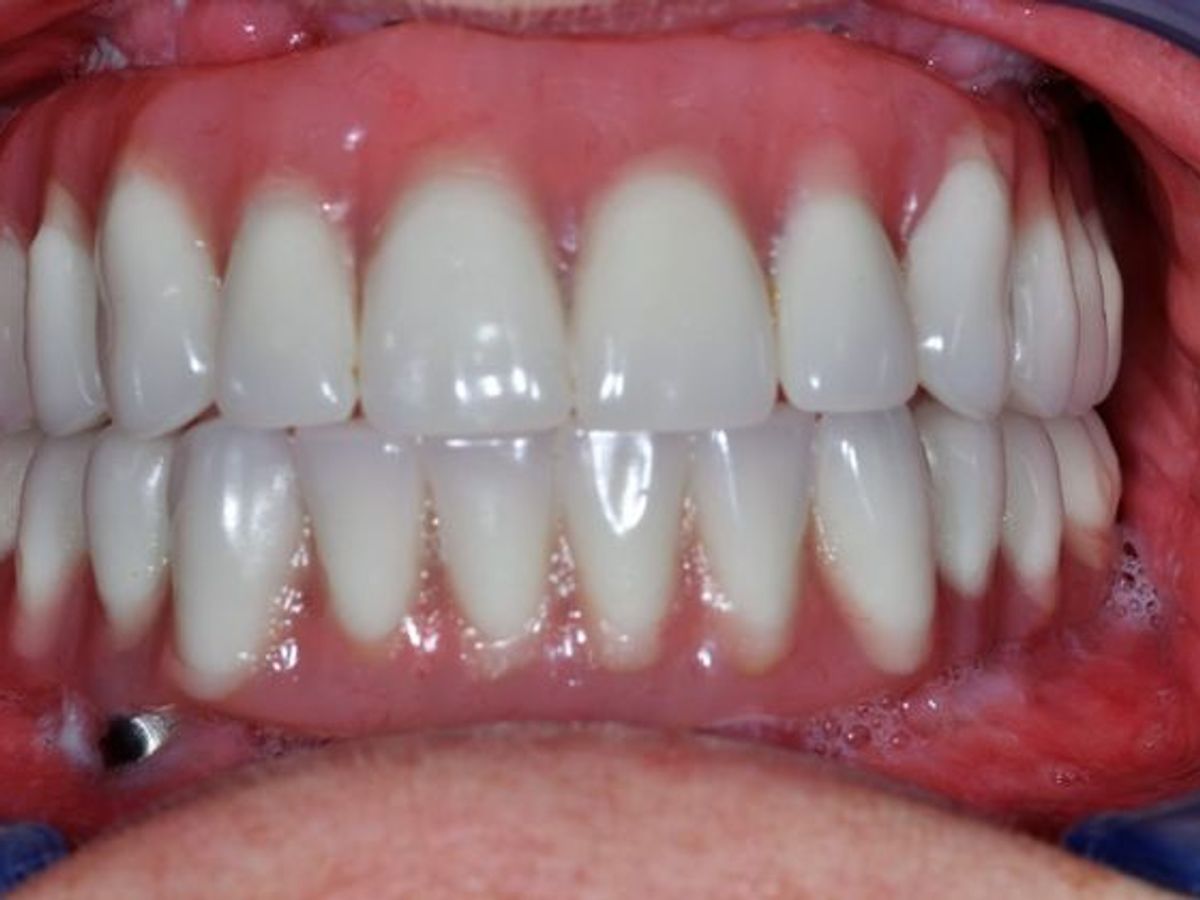 Teeth in a Day: Case 11 — Upper and Lower Arch after