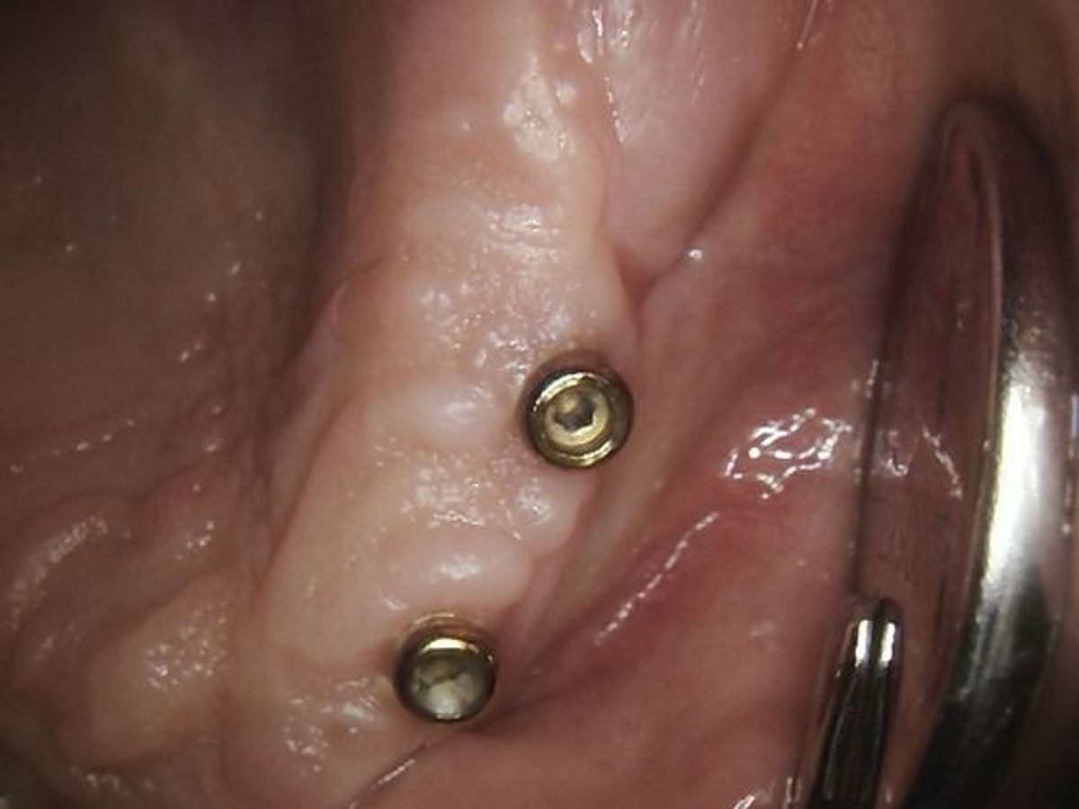 Dental Implants: Case 10 — Locator Abutments / Upper Partial Denture before