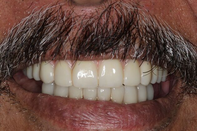 Teeth in a Day: Case 25 — Upper All on 4 and Lower Crowns after