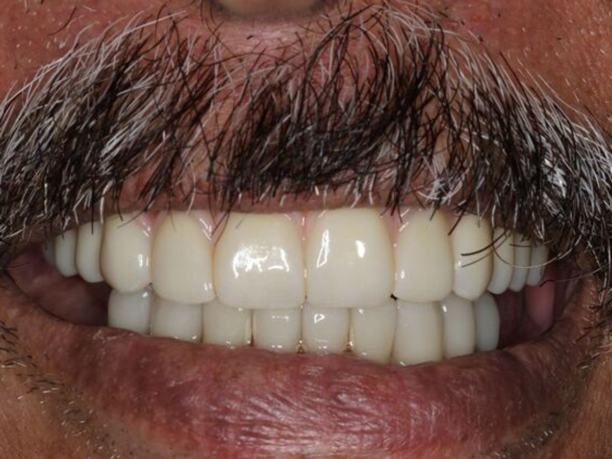 Teeth in a Day: Case 25 — Upper All on 4 and Lower Crowns after