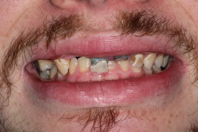 Dental Crowns: Case 31 — before