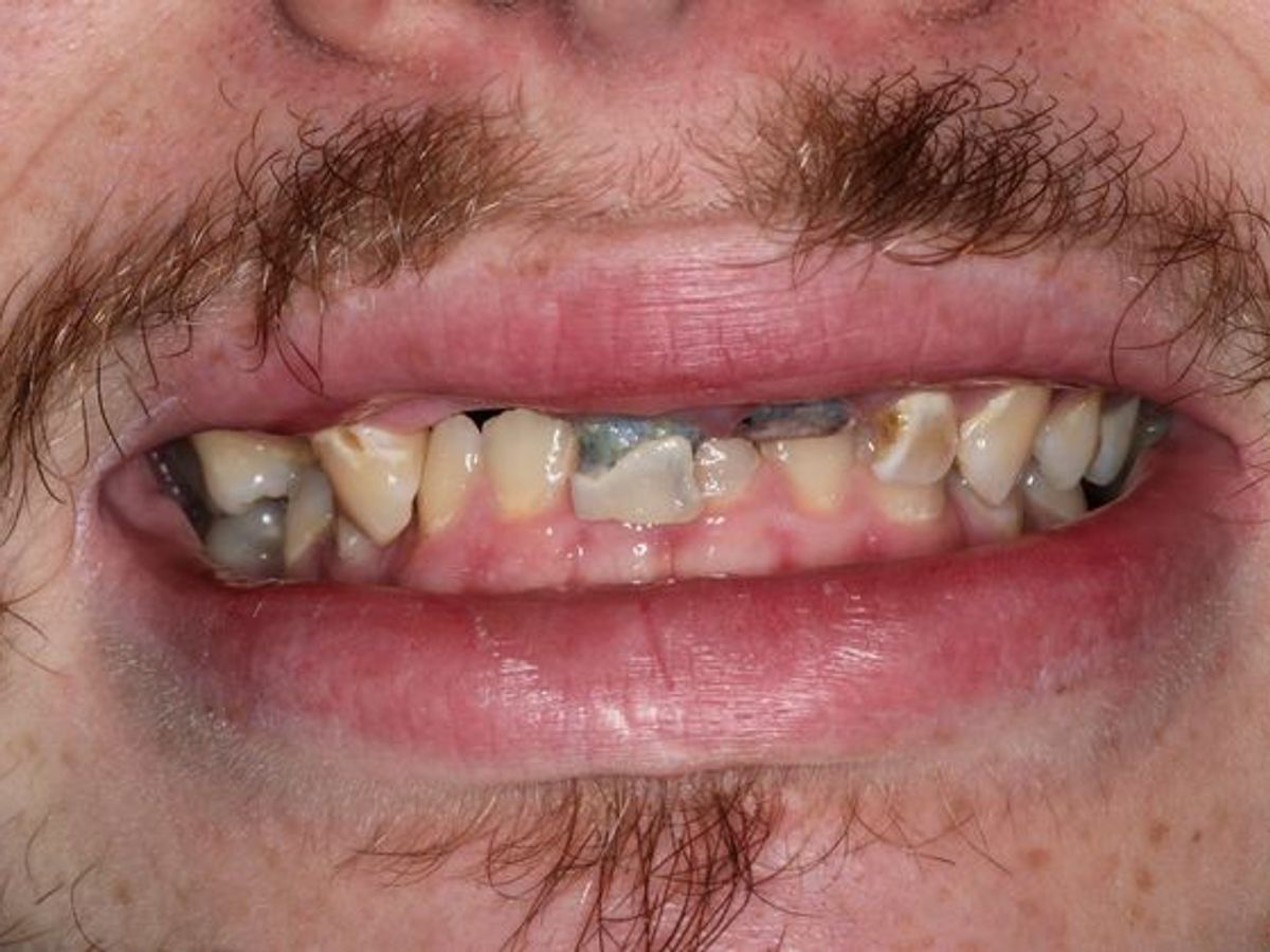 Dental Crowns: Case 31 — before