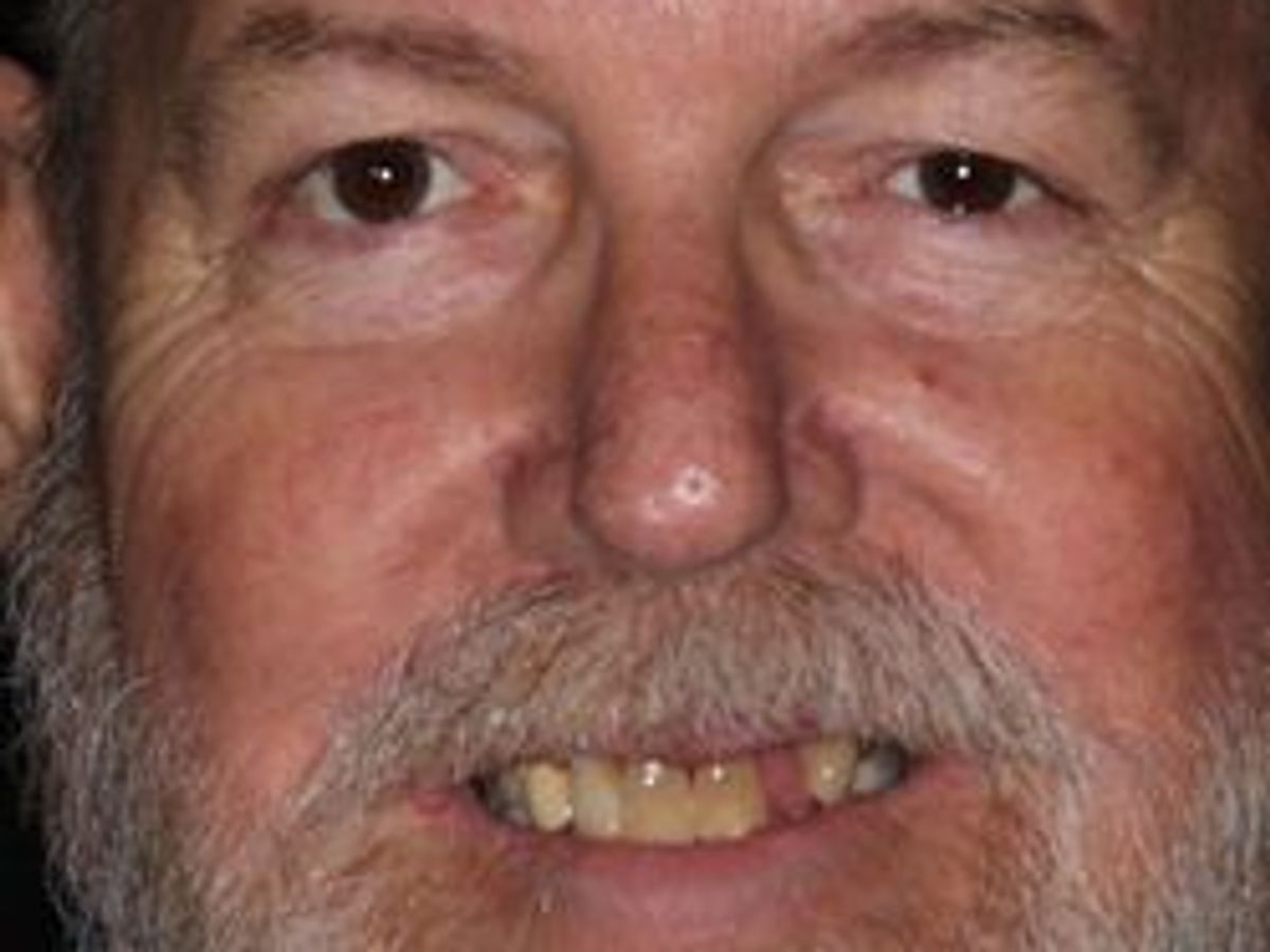 Full Mouth Reconstruction: Case 5 — before
