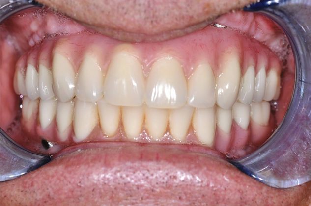 Teeth in a Day: Case 15 — Upper and Lower Arch after