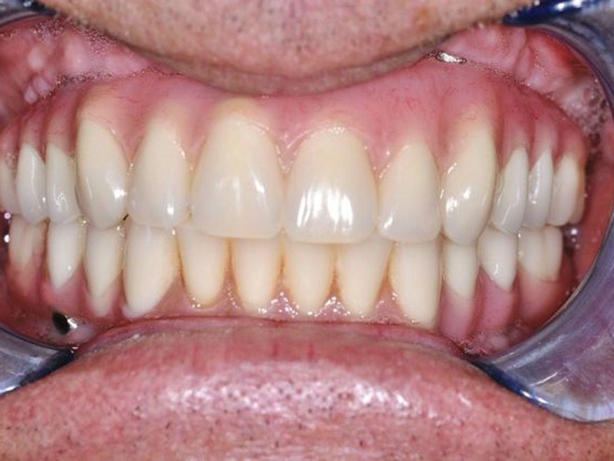 Teeth in a Day: Case 15 — Upper and Lower Arch after