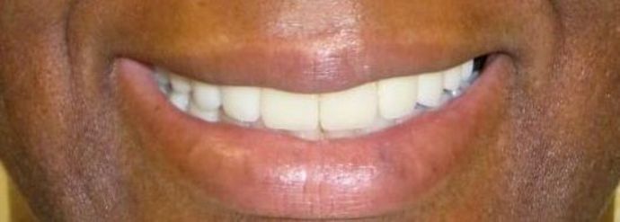 Dental Crowns: Case 16 — after