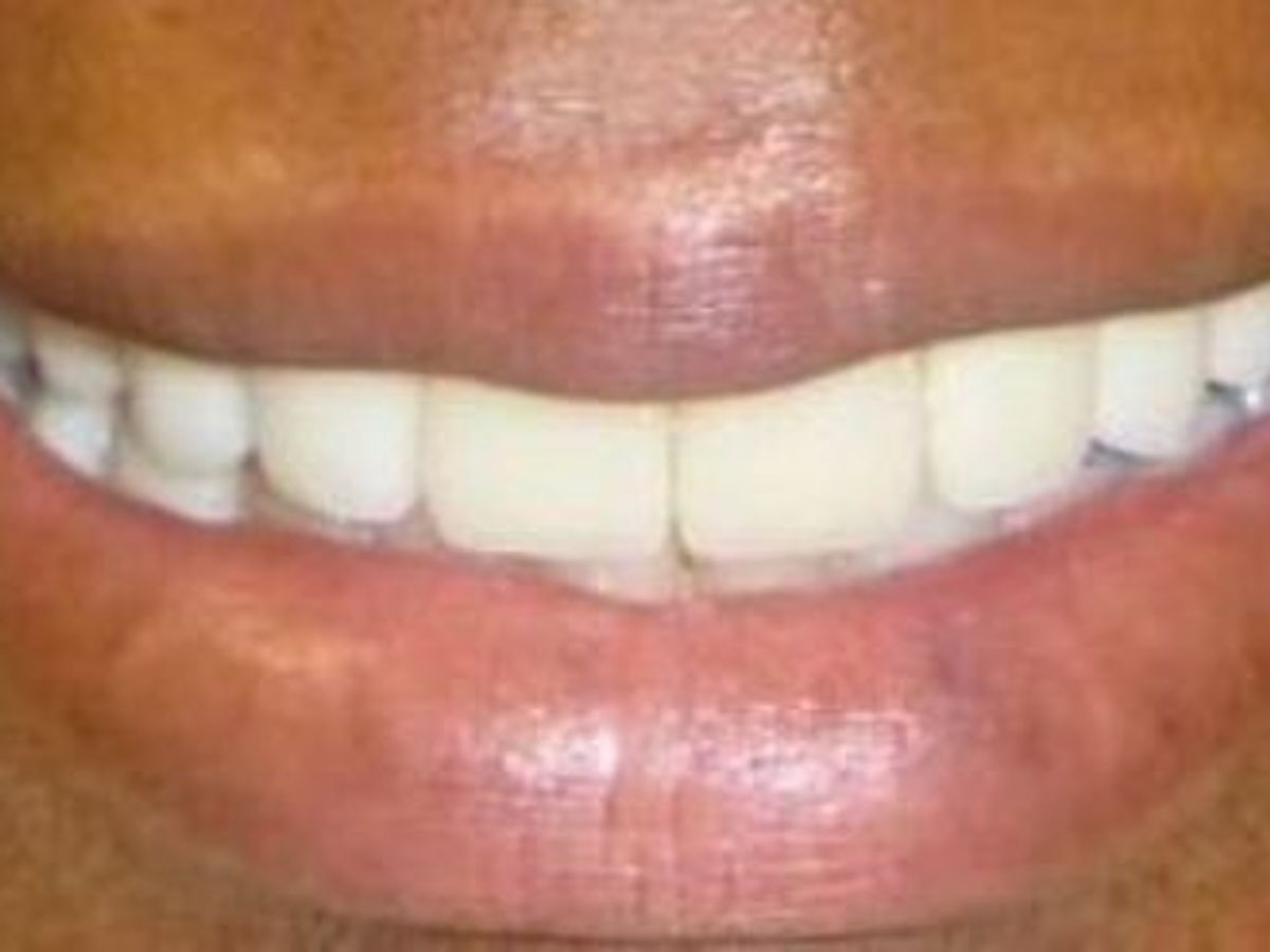Dental Crowns: Case 16 — after