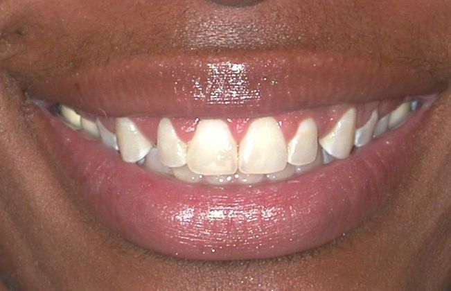 Gum Lift: Case 7 — after