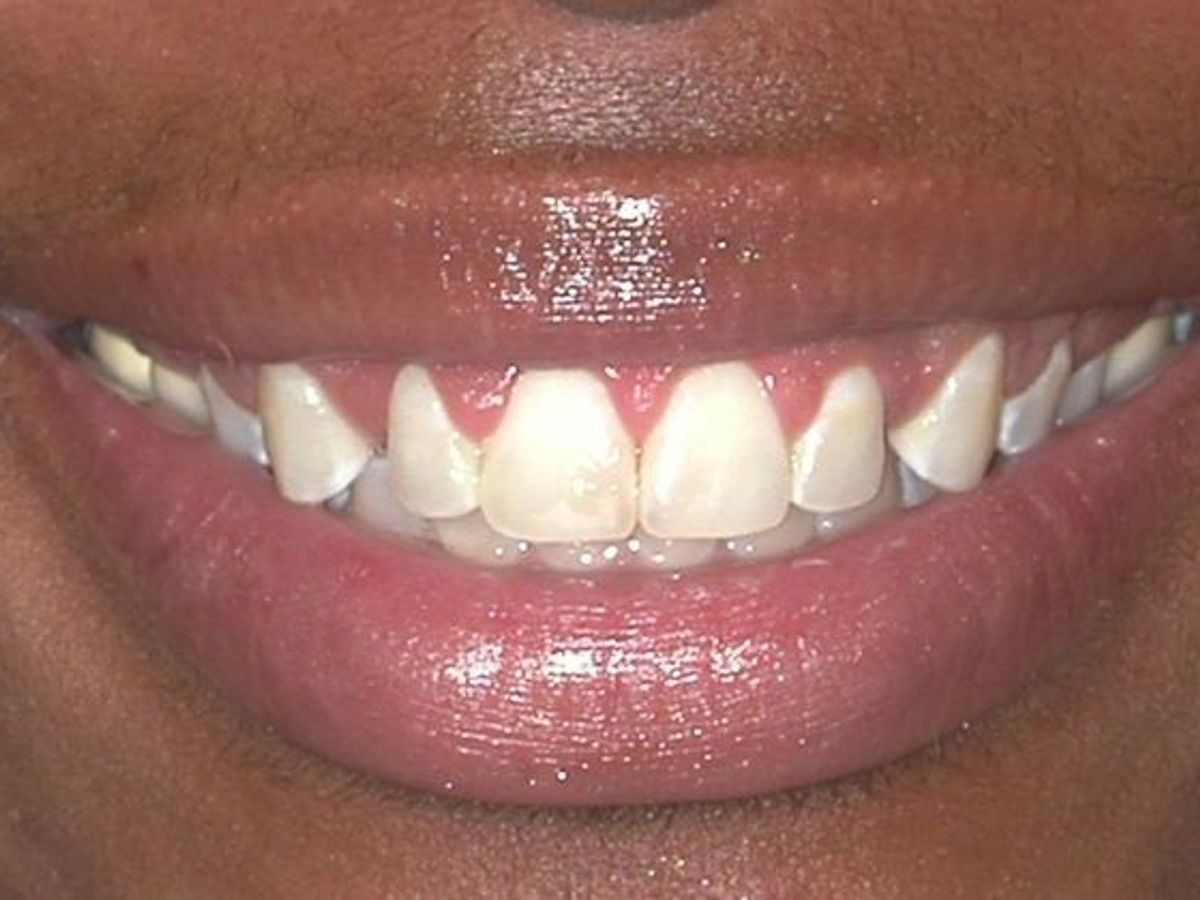 Gum Lift: Case 7 — after