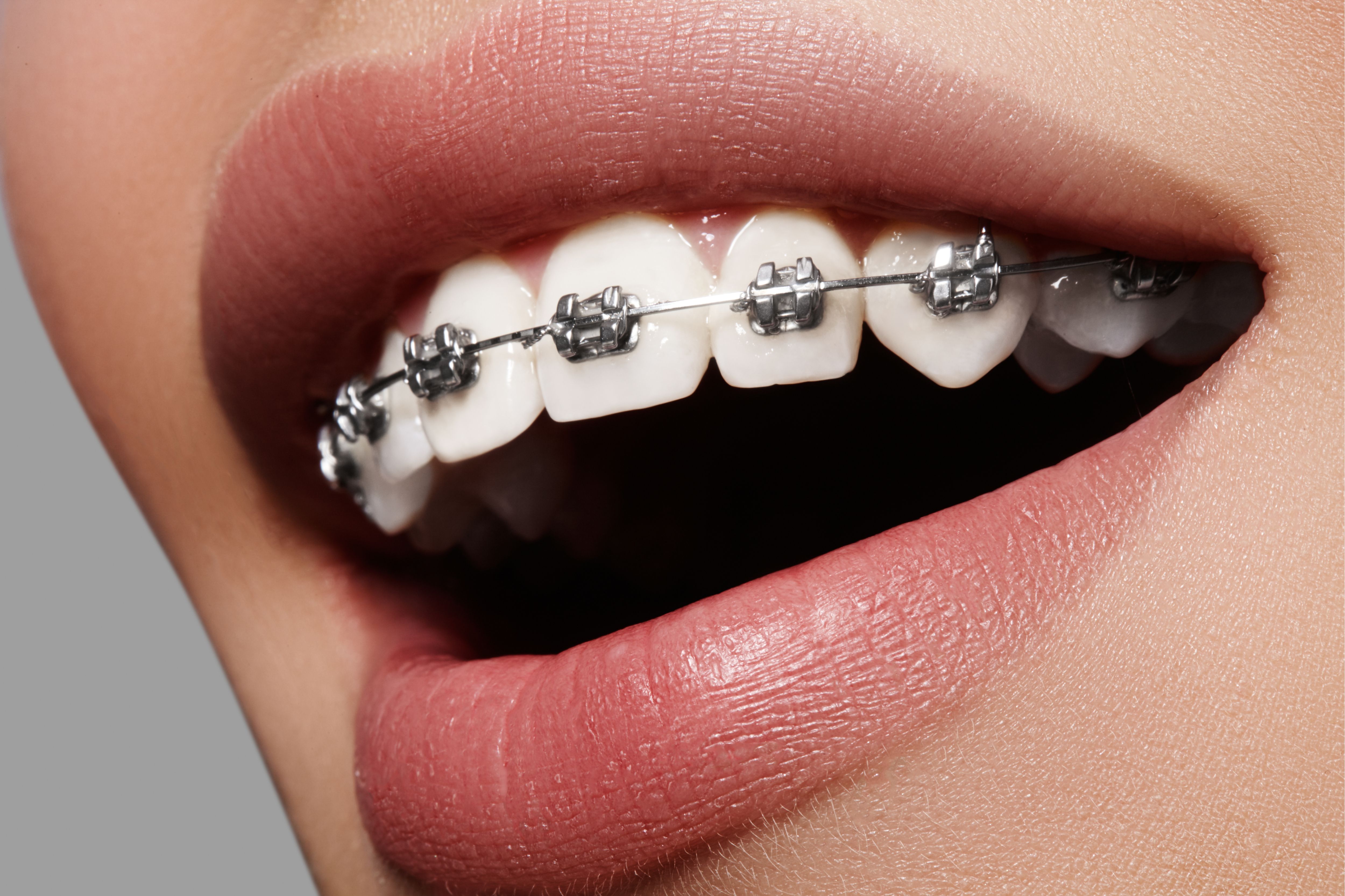 Tips for Cutting Down on Discomfort While Wearing Braces