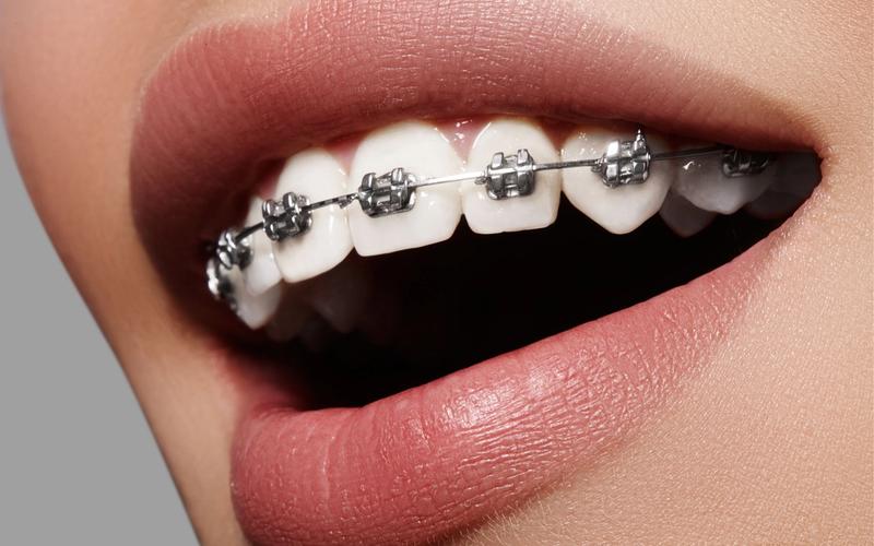 Tips for Cutting Down on Discomfort While Wearing Braces