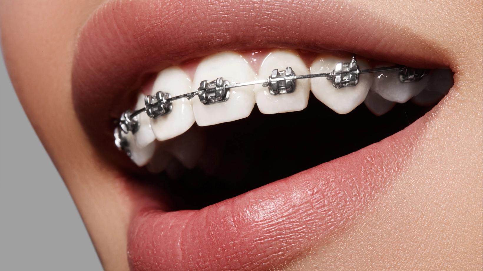 Tips for Cutting Down on Discomfort While Wearing Braces