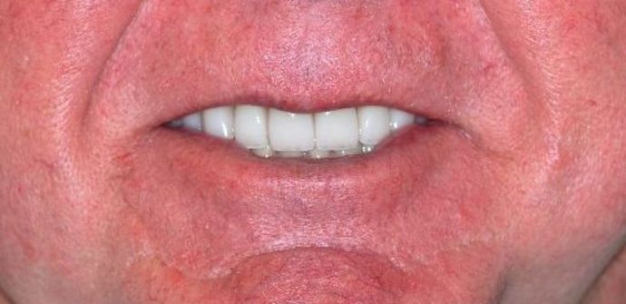 Dental Crowns: Case 18 — after