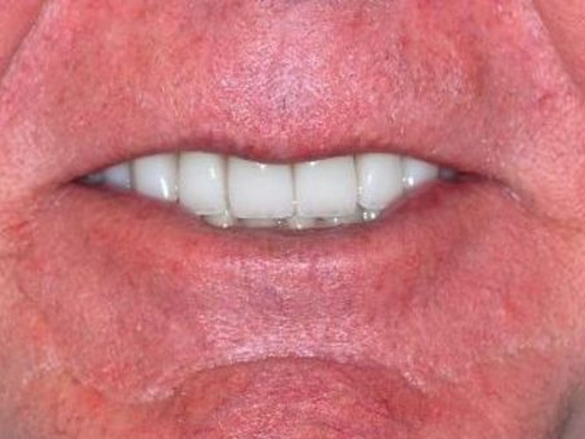 Dental Crowns: Case 18 — after
