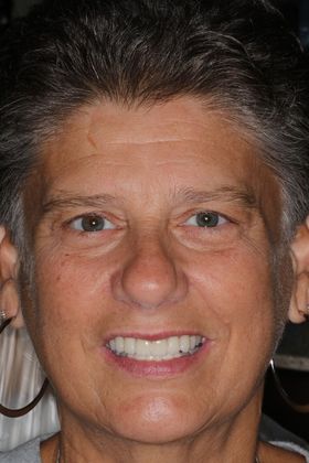 Dental Crowns: Case 30 — after