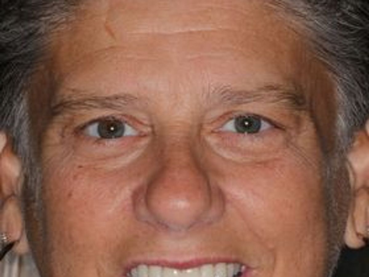 Dental Crowns: Case 30 — after