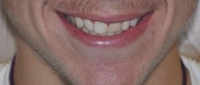 Gum Lift: Case 4 — after