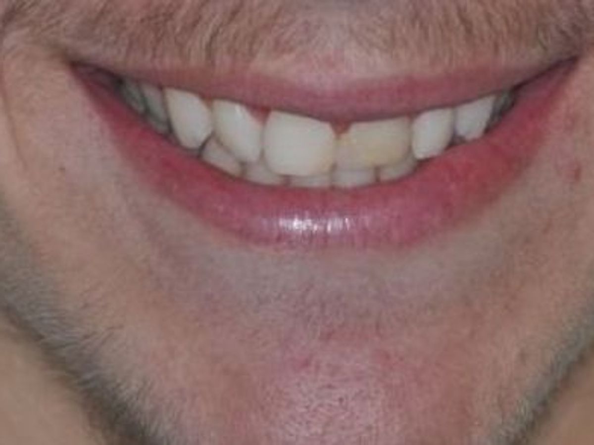 Gum Lift: Case 4 — after