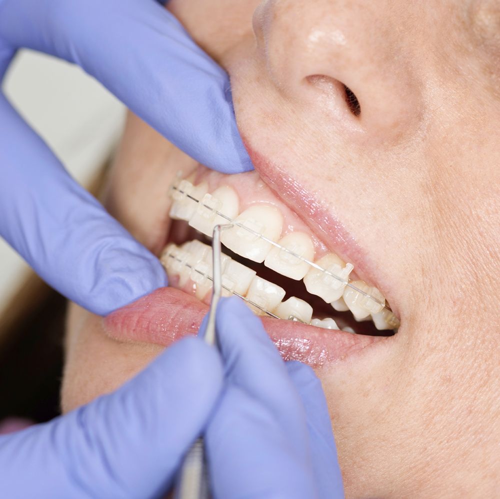 Signs Your Child Might Need Orthodontics