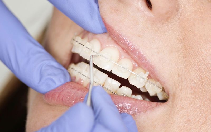 Signs Your Child Might Need Orthodontics