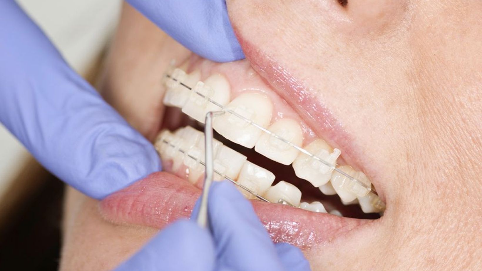 Signs Your Child Might Need Orthodontics