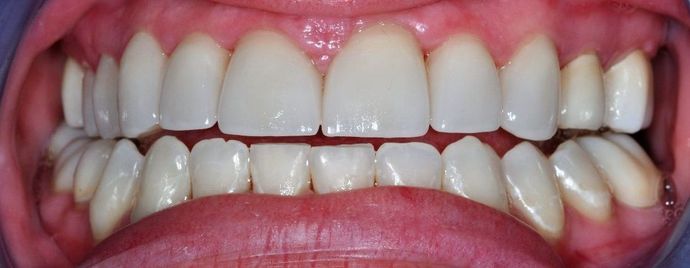 Dental Crowns: Case 8 — after