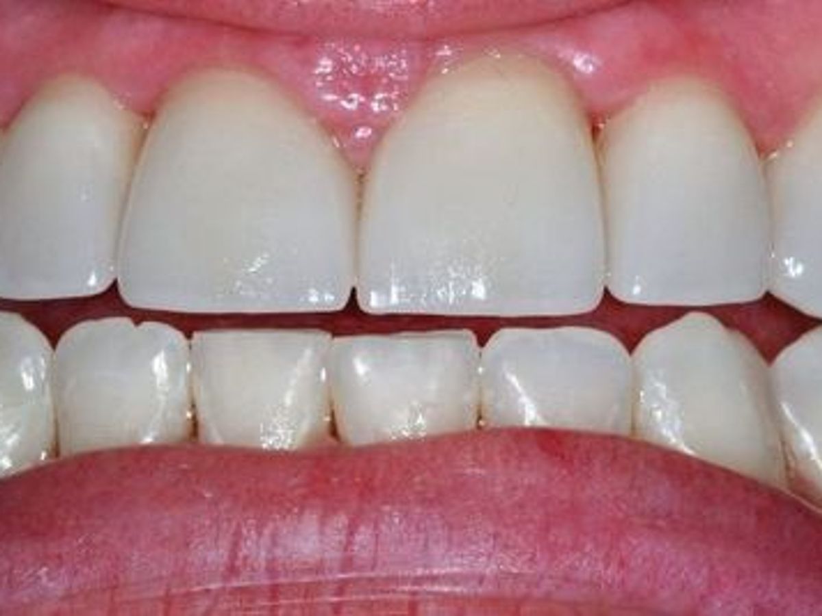 Dental Crowns: Case 8 — after