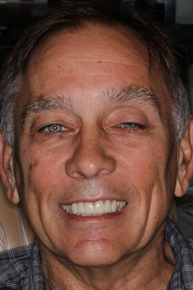 Veneers: Case 31 — after