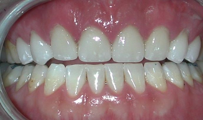 Veneers: Case 3 — after