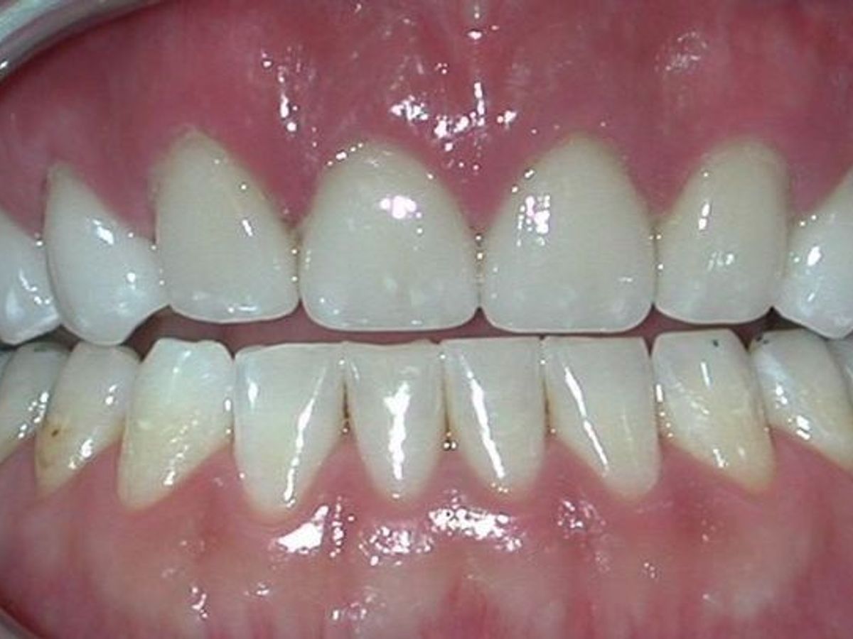 Veneers: Case 3 — after