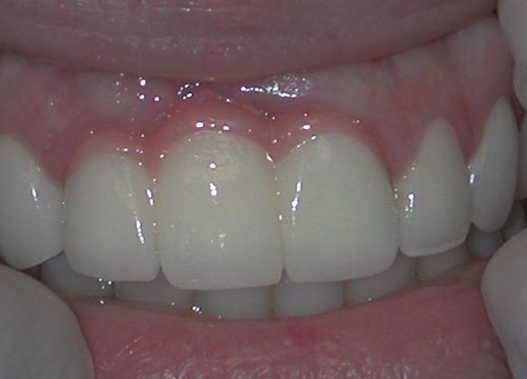 Dental Crowns: Case 24 — before