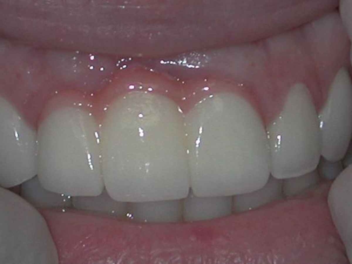 Dental Crowns: Case 24 — before