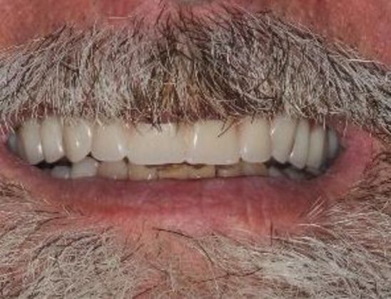 Dentures: Case 5 — after