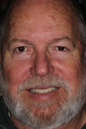 Full Mouth Reconstruction: Case 5 — after
