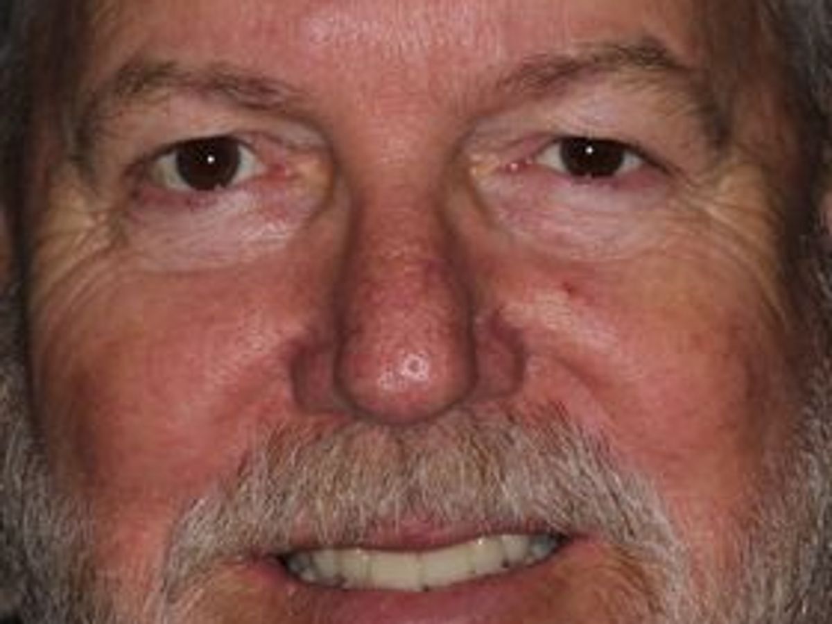 Full Mouth Reconstruction: Case 5 — after