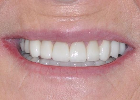 Full Mouth Reconstruction: Case 1 — after