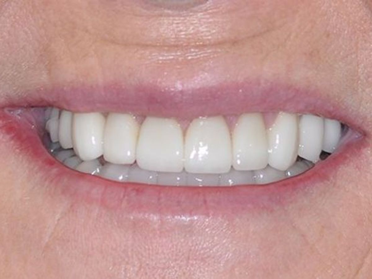 Full Mouth Reconstruction: Case 1 — after