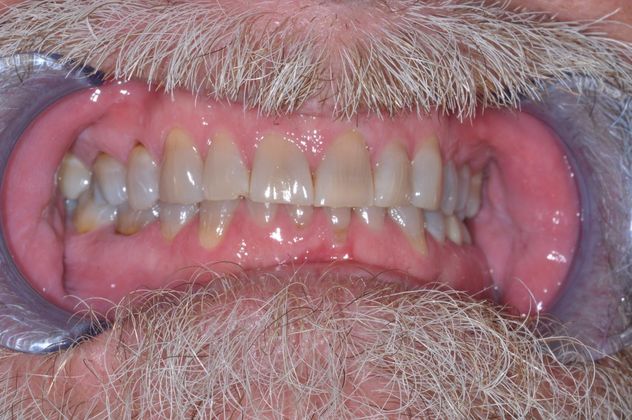 Full Mouth Reconstruction: Case 8 — before