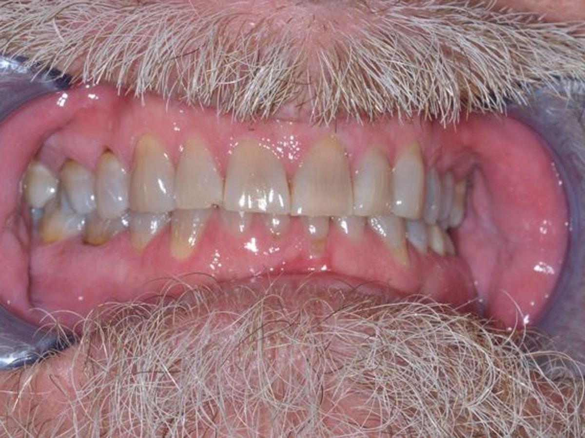 Full Mouth Reconstruction: Case 8 — before