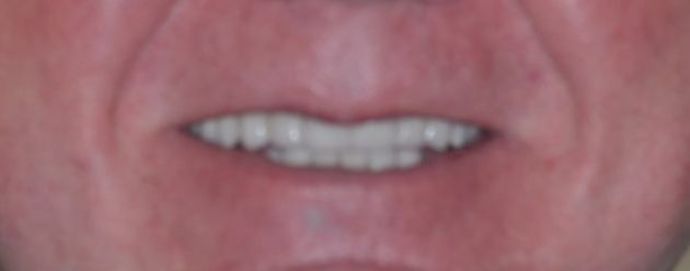 Dental Crowns: Case 18 — before