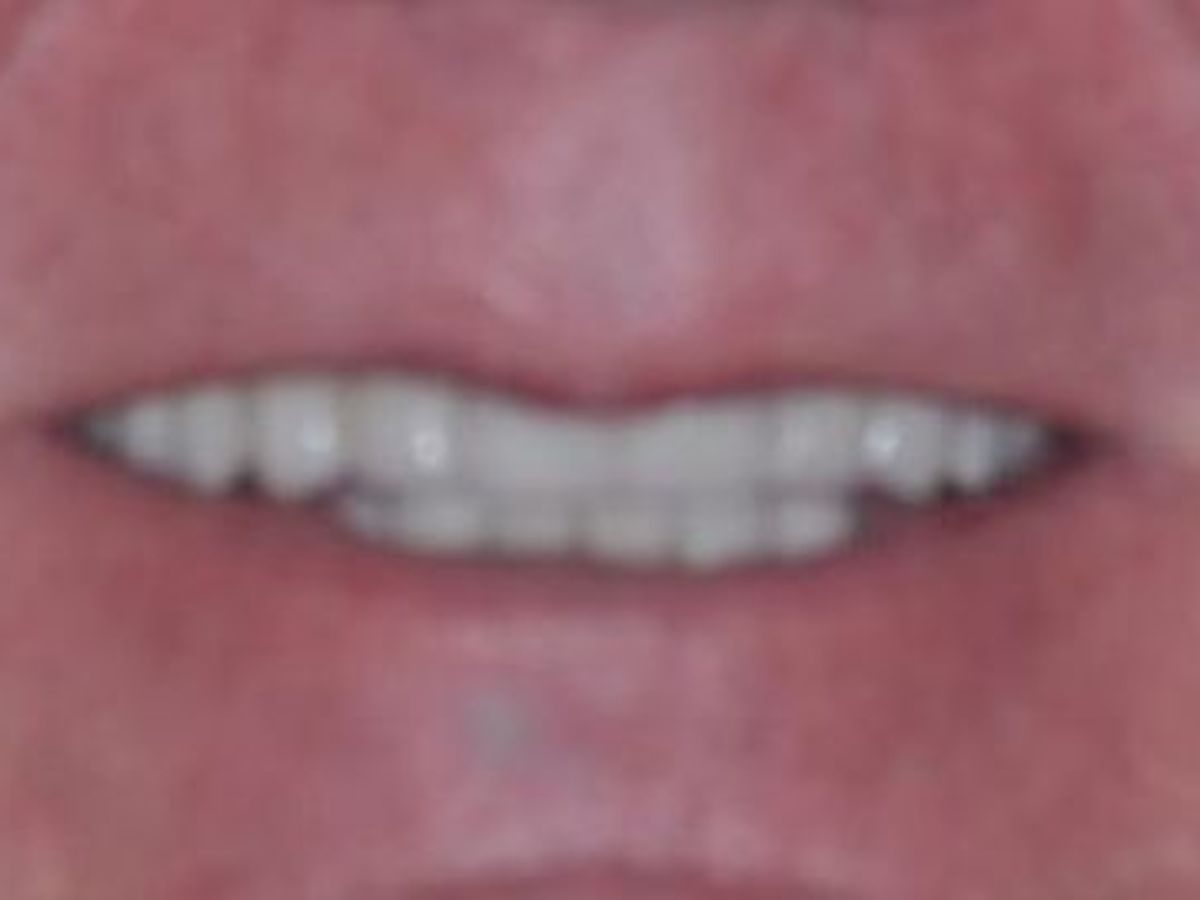 Dental Crowns: Case 18 — before
