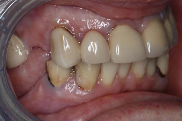 Dentures: Case 11 — before