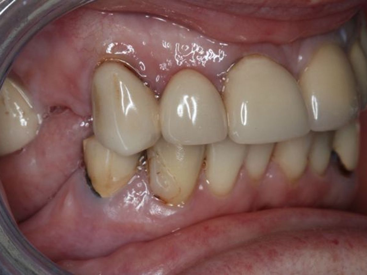Dentures: Case 11 — before