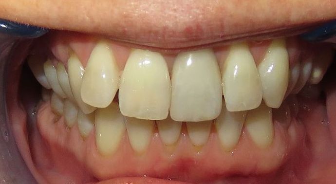 Veneers: Case 5 — before