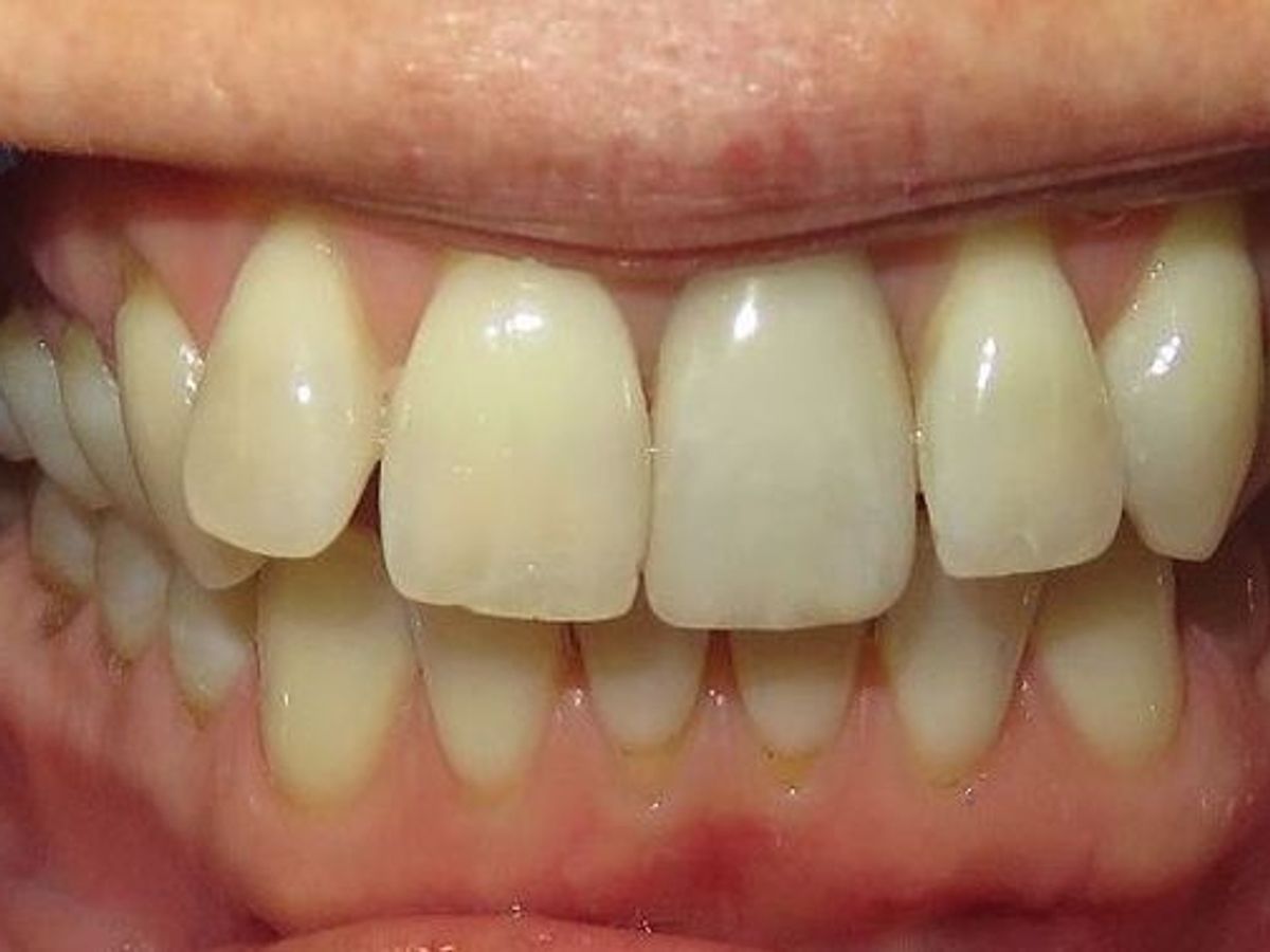 Veneers: Case 5 — before