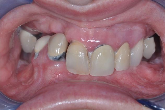 Teeth in a Day: Case 11 — Upper and Lower Arch before
