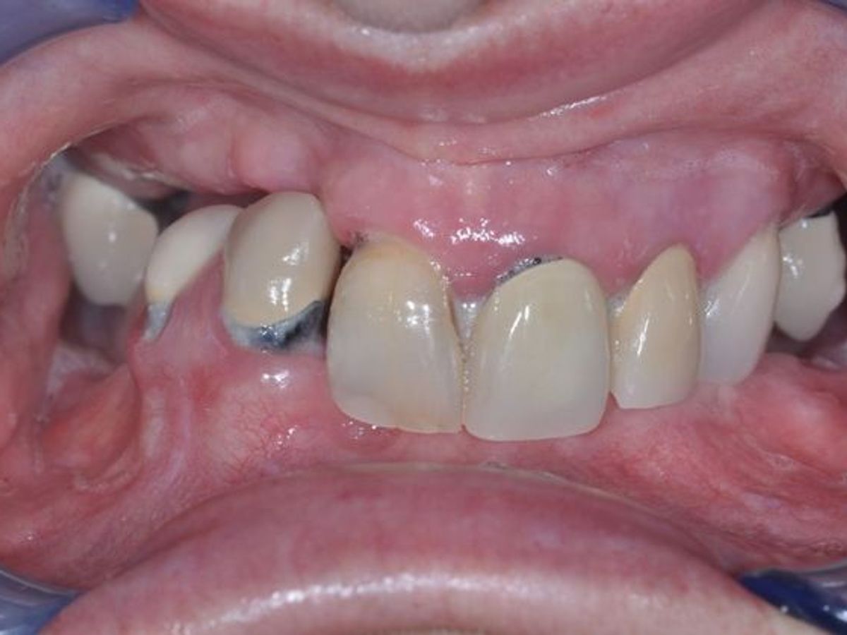 Teeth in a Day: Case 11 — Upper and Lower Arch before