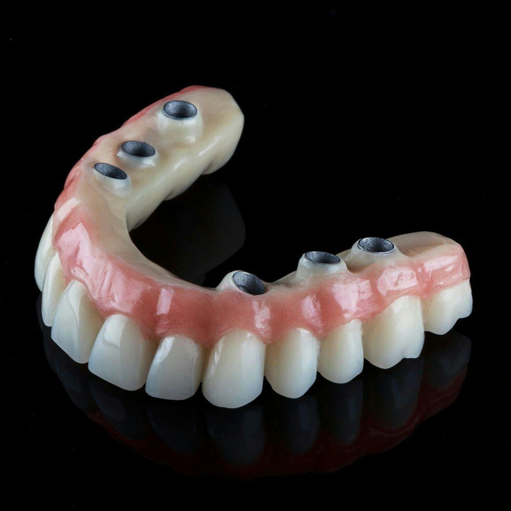 All-on-4 dentures